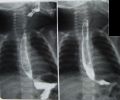 syndrome allgrove radiogrphie