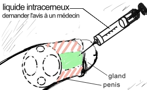 injection corps caverneux